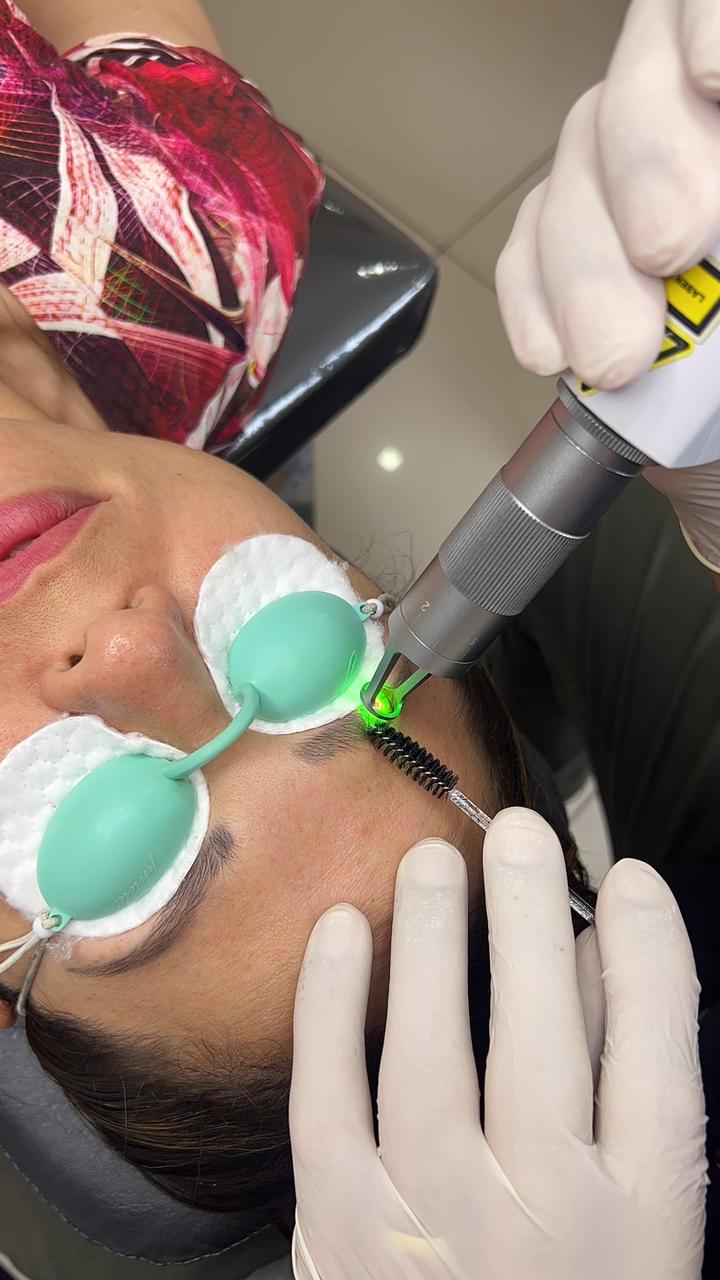 Remoção de micropigmentação a laser