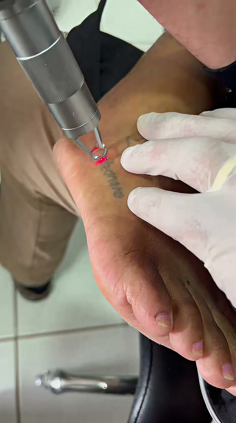 Remoção de tatuagem a laser