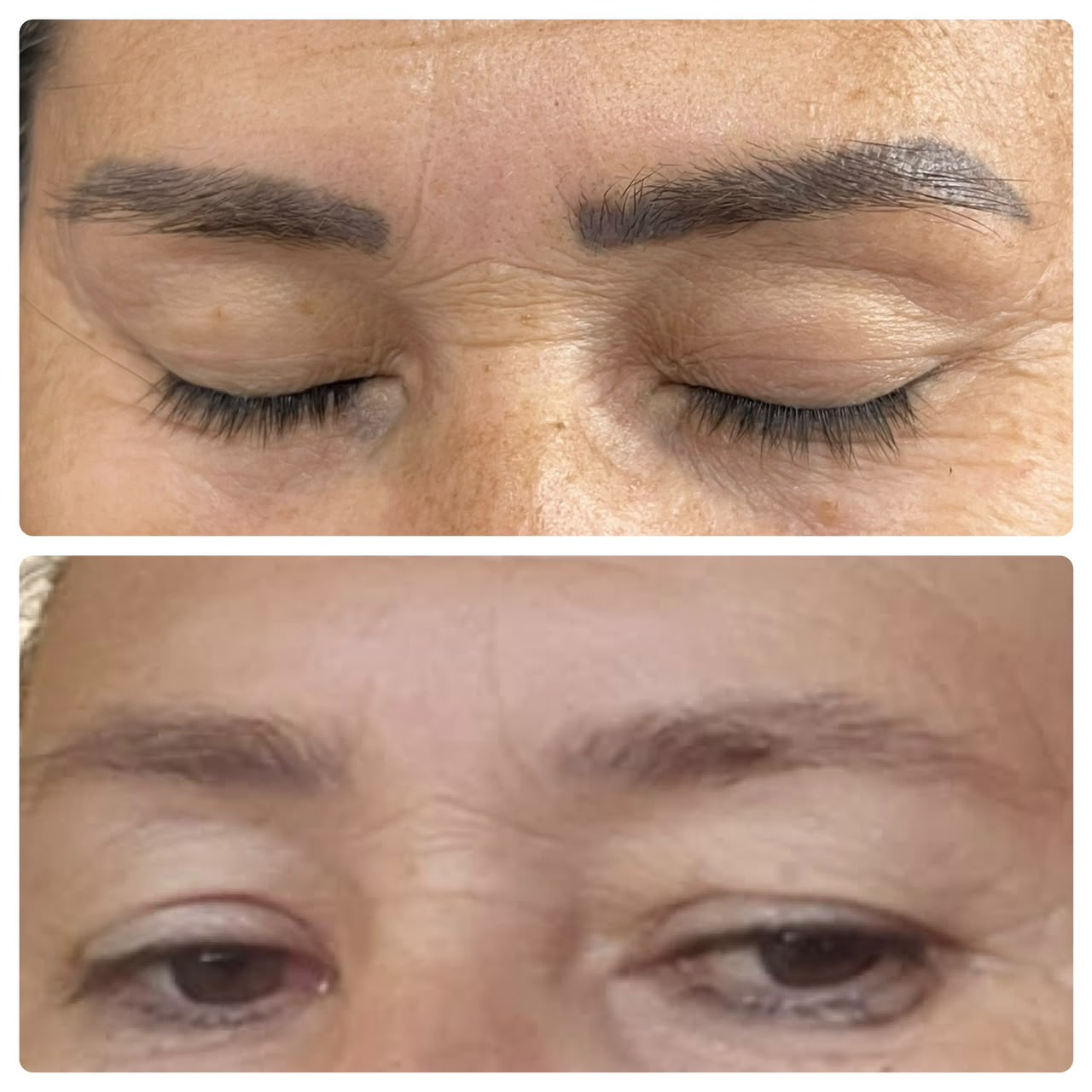 Resultado real de remoção a laser — antes e depois