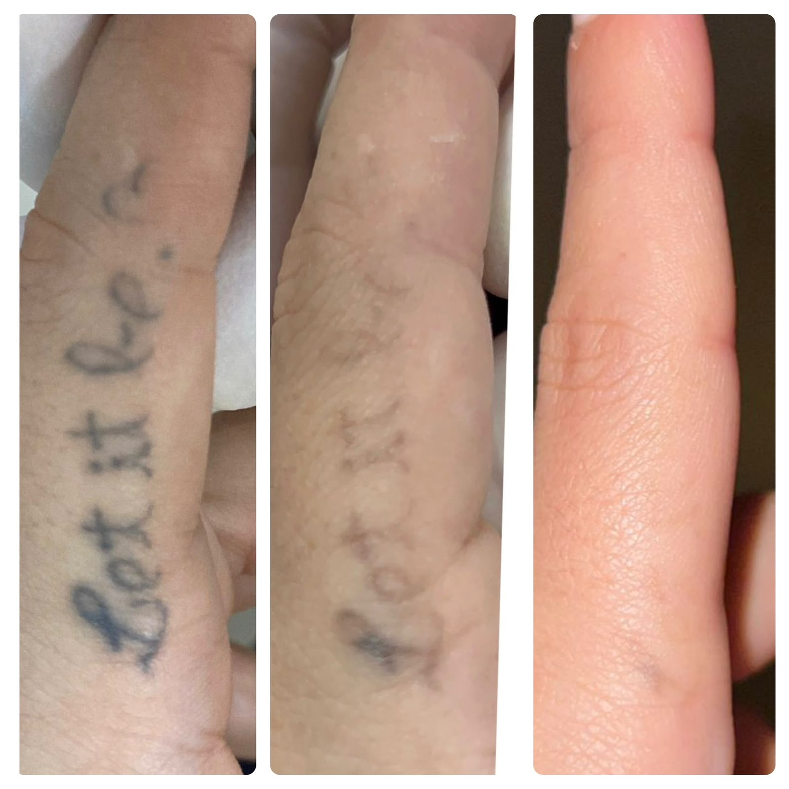 Resultado real de remoção a laser — antes e depois