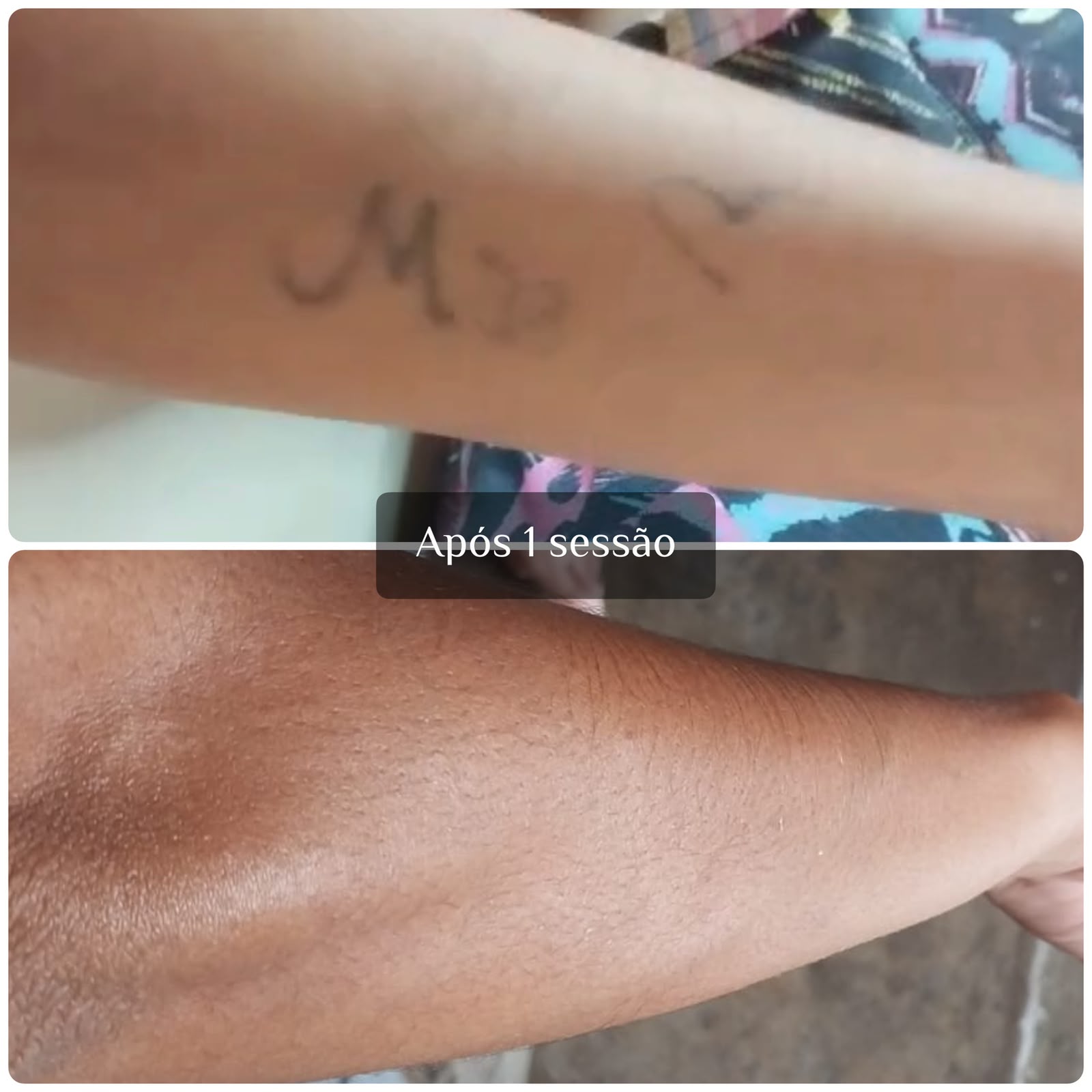 Resultado real de remoção a laser — antes e depois