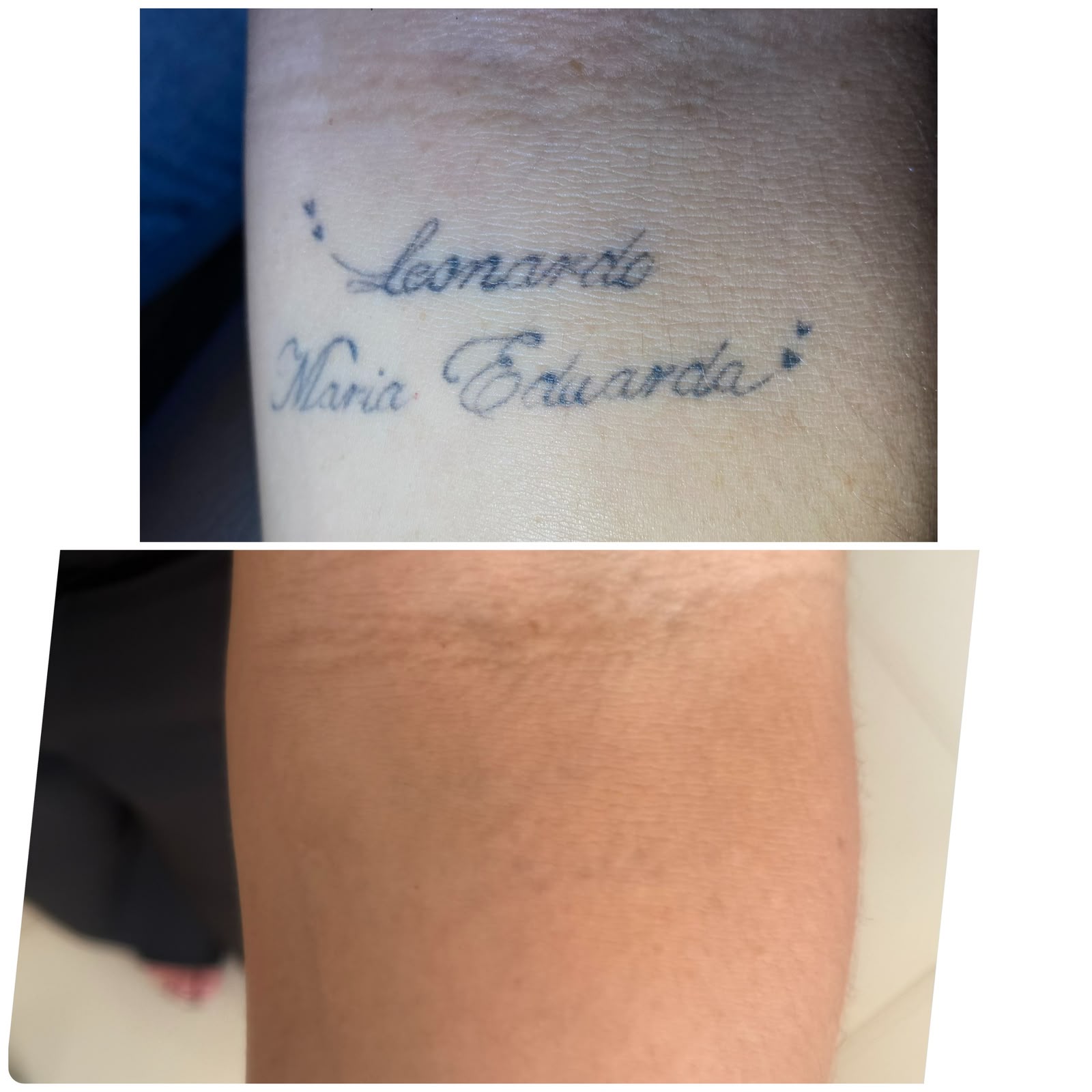 Resultado real de remoção a laser — antes e depois
