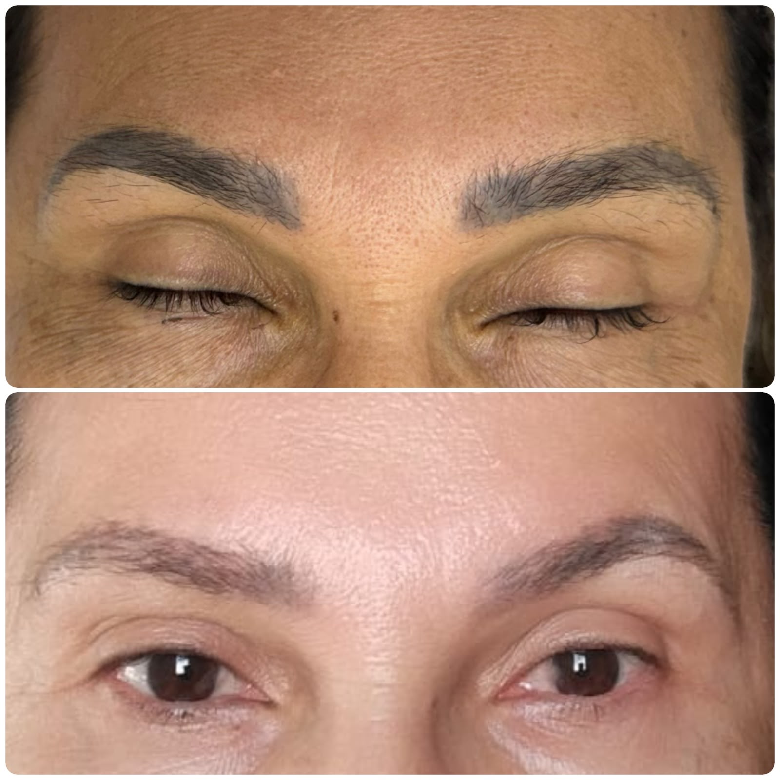 Resultado real de remoção a laser — antes e depois