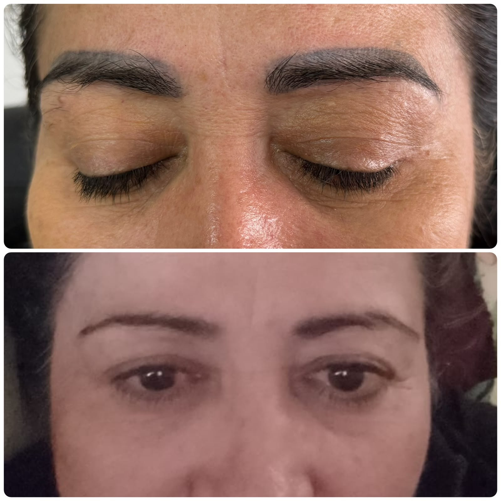 Resultado real de remoção a laser — antes e depois