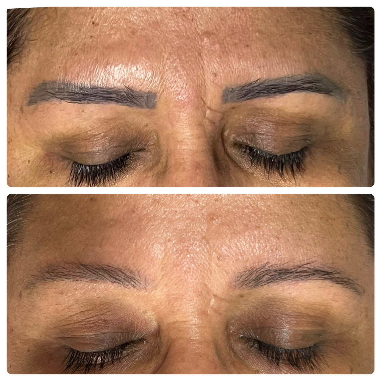 Resultado real de remoção a laser — antes e depois