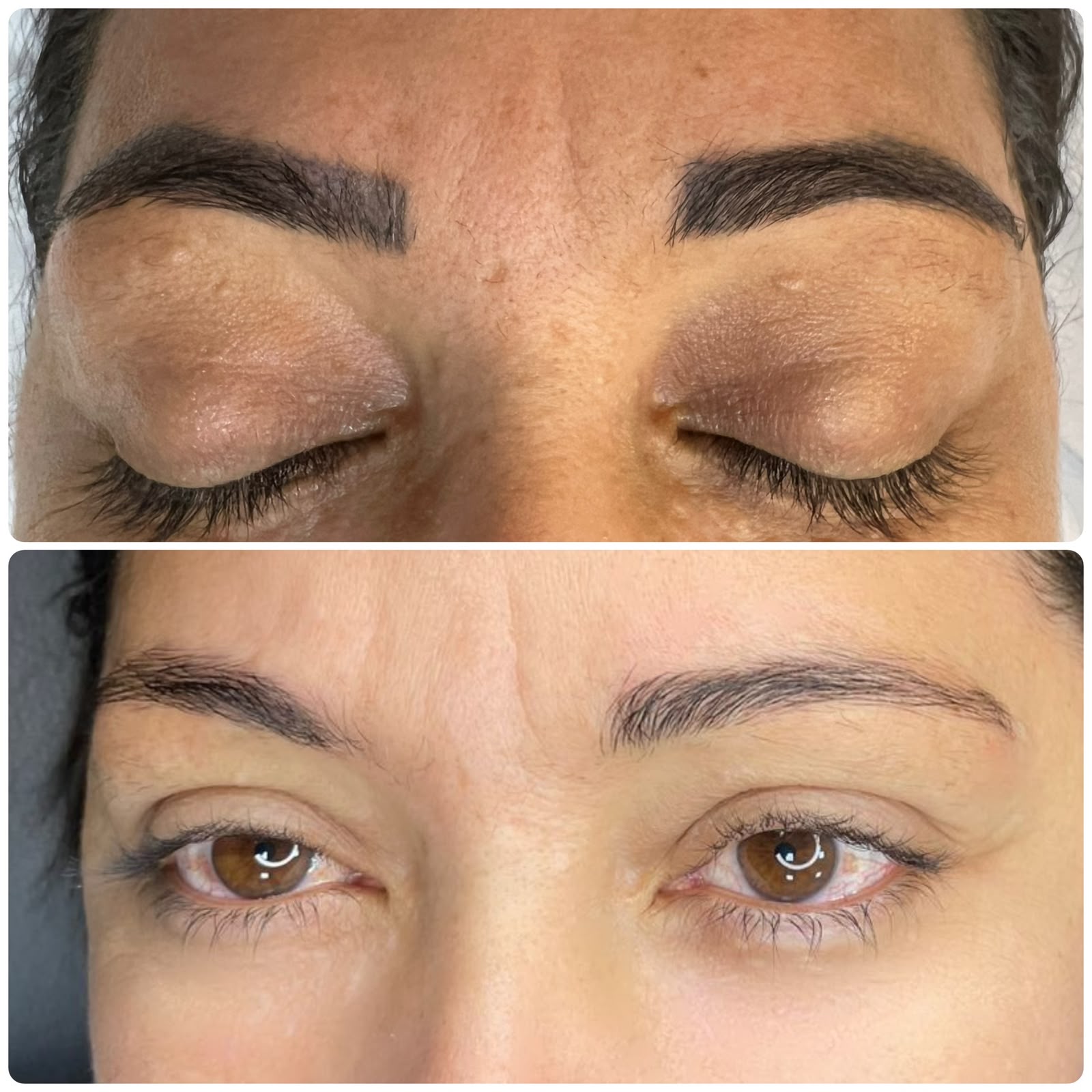 Resultado real de remoção a laser — antes e depois