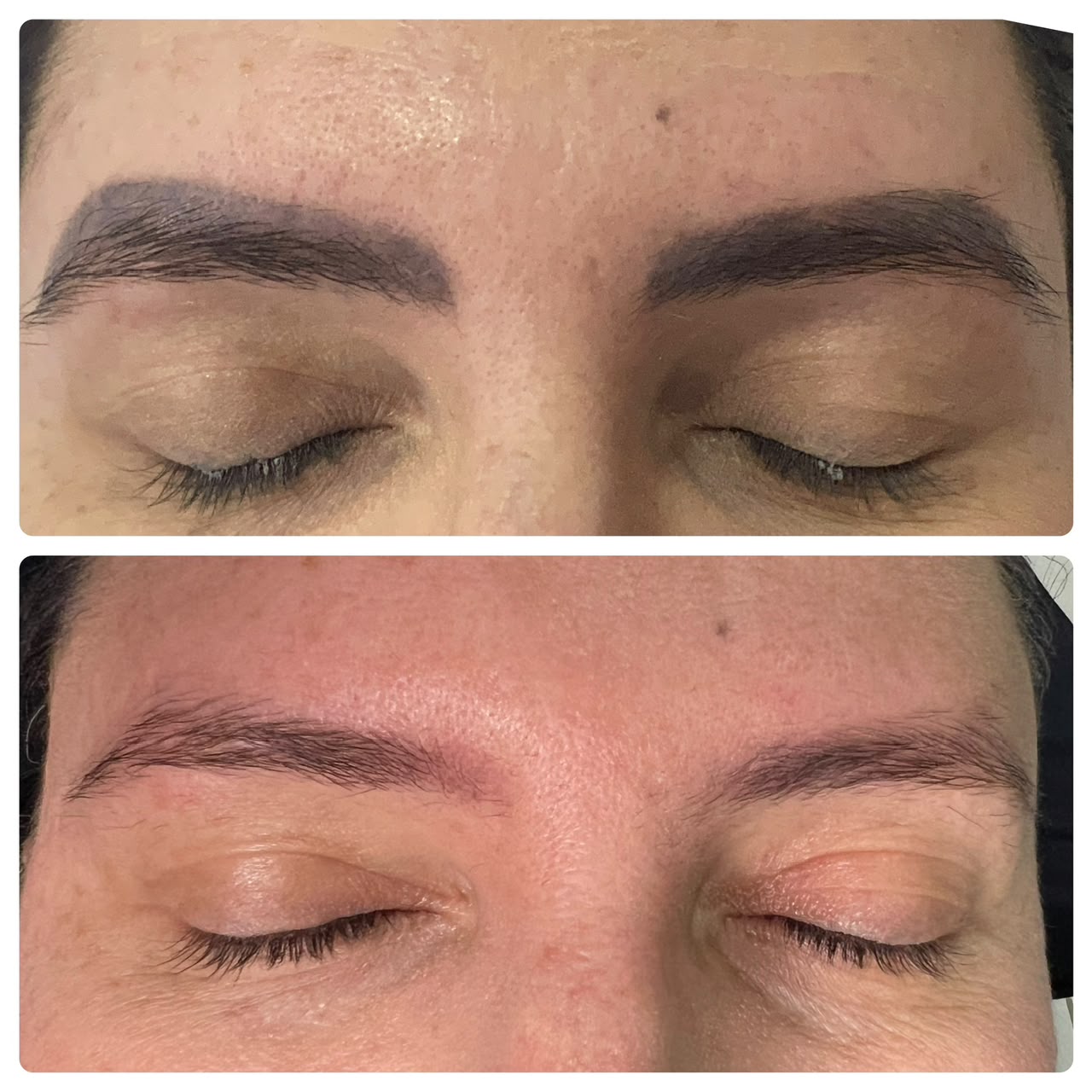 Resultado real de remoção a laser — antes e depois