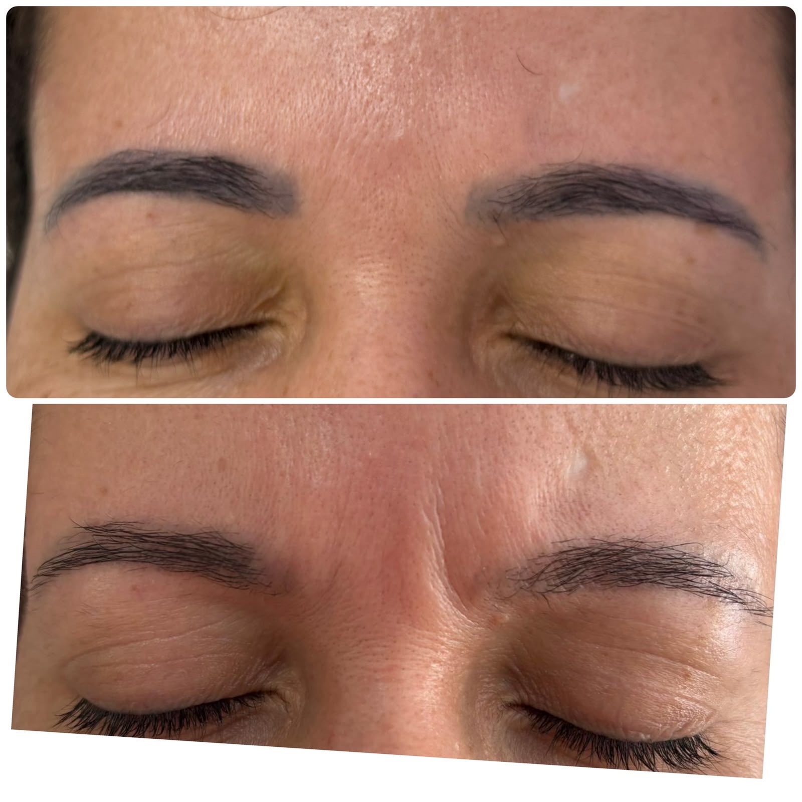 Resultado real de remoção a laser — antes e depois
