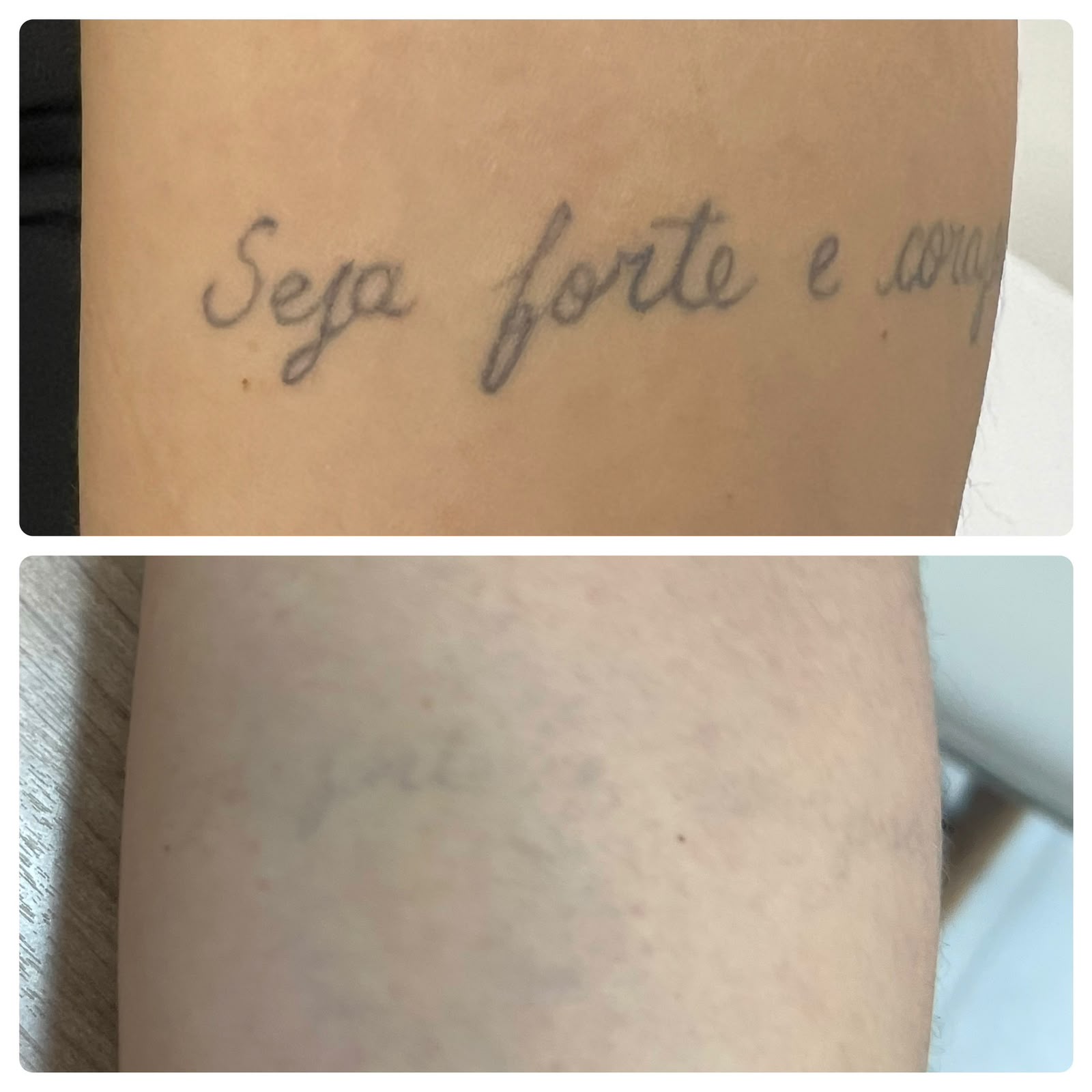 Resultado real de remoção a laser — antes e depois