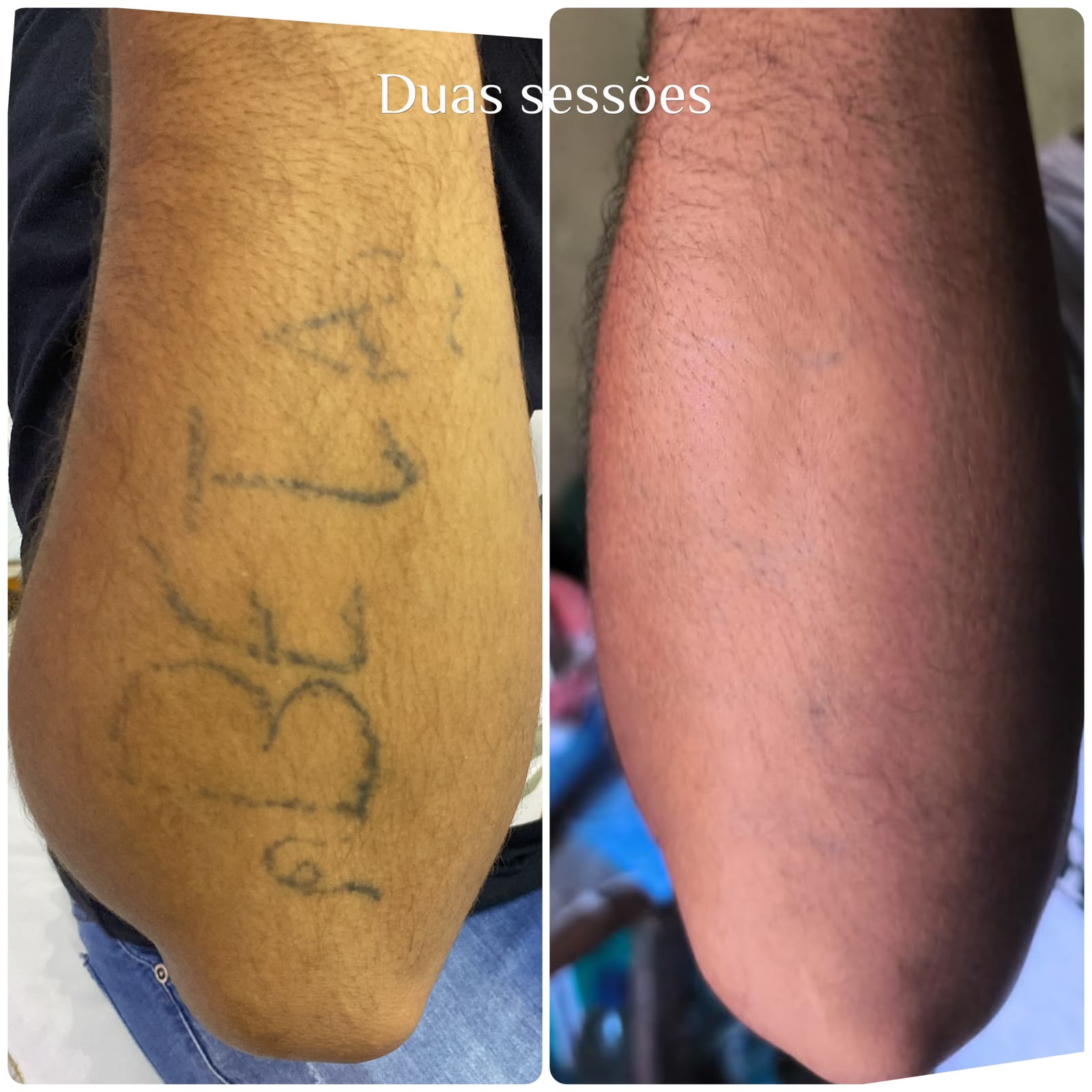 Resultado real de remoção a laser — antes e depois