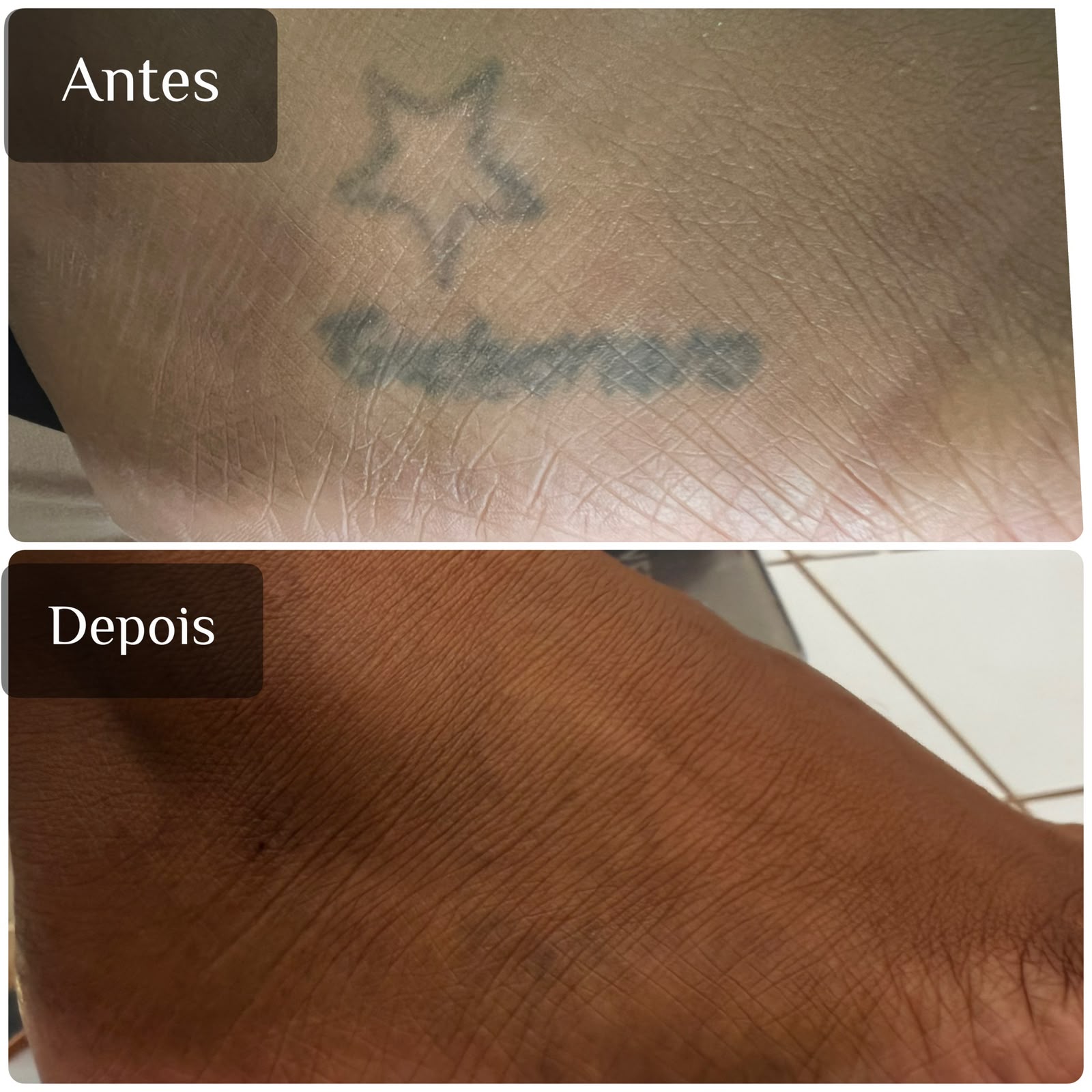 Resultado real de remoção a laser — antes e depois